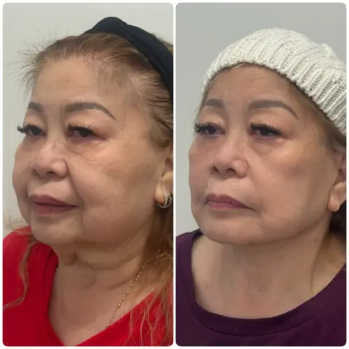 Deep plane facelift and neck lift, left oblique, patient in her 60s, 3 months post-op, case 4