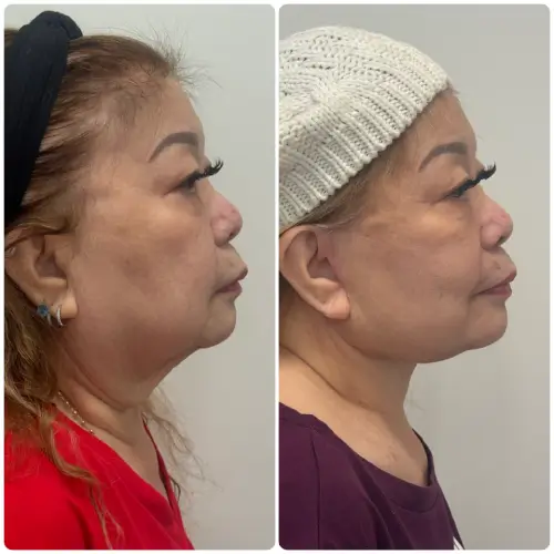 Deep plane facelift and neck lift, right profile, patient in her 60s, 3 months post-op, case 4