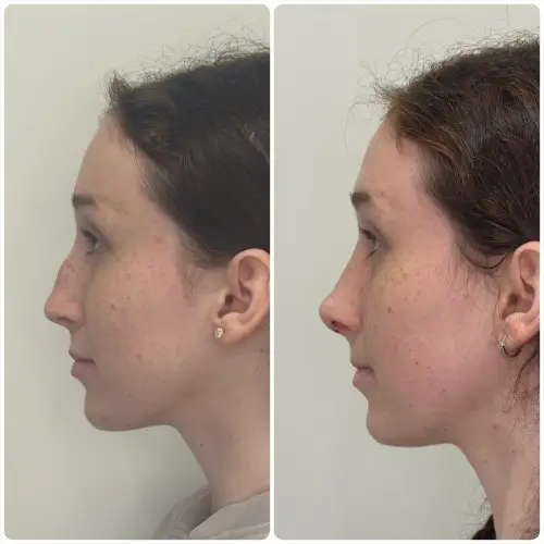 Rhinoplasty, left profile, patient in her 20s, profile and tip refinement, 1 month post-op, case 4