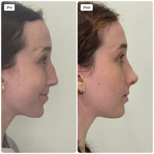 Rhinoplasty, right profile, patient in her 20s, profile and tip refinement, 1 month post-op, case 4