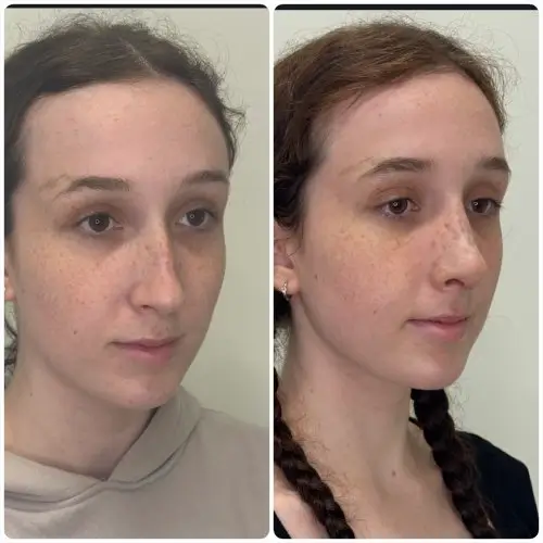 Rhinoplasty, right oblique, patient in her 20s, profile and tip refinement, 1 month post-op, case 4