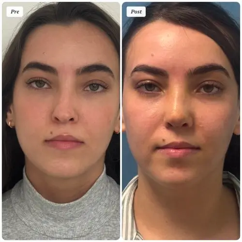 Rhinoplasty, front view, patient in her 20s, function and appearance, 6 months post-op, case 2