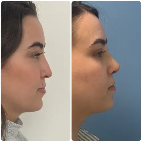 Rhinoplasty, right profile, patient in her 20s, function and appearance, 6 months post-op, case 2