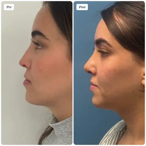 Rhinoplasty, left profile, patient in her 20s, function and appearance, 6 months post-op, case 2
