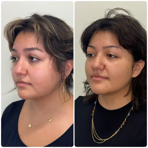 Buccal Fat Removal, left oblique, patient in her late 20s, lower face sculpting, case 4