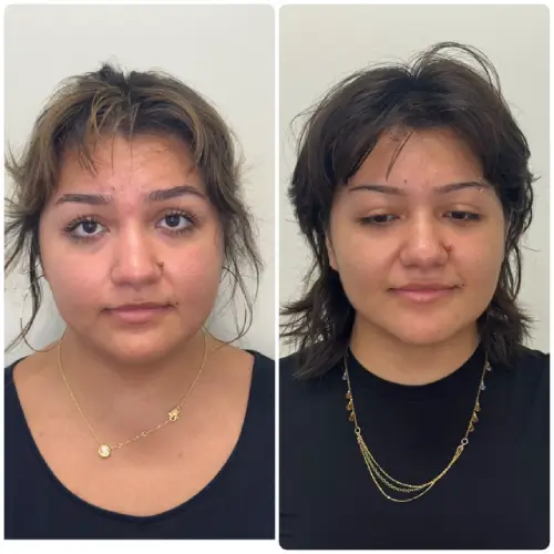Buccal Fat Removal, front view, patient in her late 20s, lower face sculpting, case 4