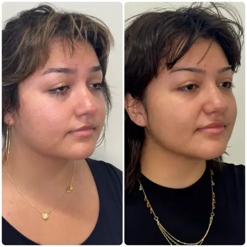 Buccal Fat Removal, right oblique, patient in her late 20s, lower face sculpting, case 4