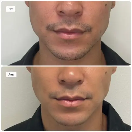 Buccal Fat Removal, front view, patient in his 20s, lower face sculpting, case 2