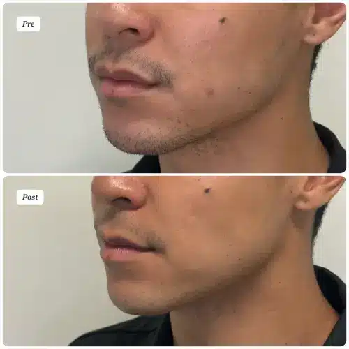Buccal Fat Removal, left oblique, patient in his 20s, lower face sculpting, case 2