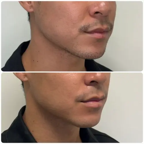 Buccal Fat Removal, right oblique, patient in his 20s, lower face sculpting, case 2