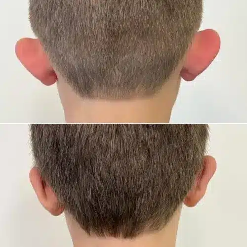 Otoplasty ear pinning, back view, 8-year-old patient