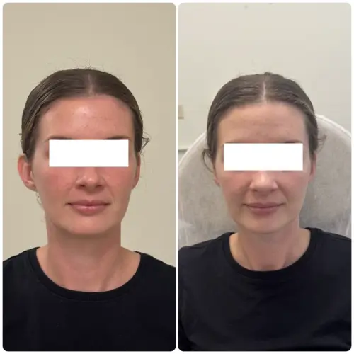 Otoplasty ear pinning, rear oblique view, patient in her 20s