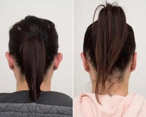 Otoplasty ear pinning, back view, patient in her 30s