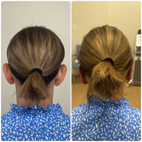 Otoplasty ear pinning, back view, patient in her 50s