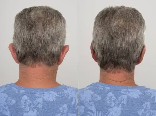Otoplasty ear pinning, back view, patient in his 50s