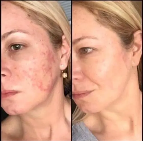 Morpheus8 RF microneedling, profile view, result 3