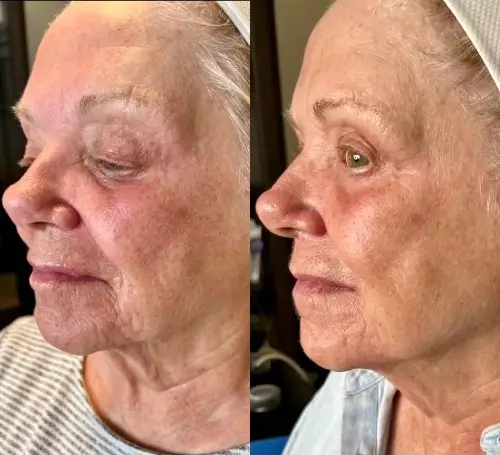 Morpheus8 RF microneedling, profile view, result 2