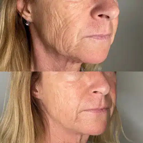 Morpheus8 RF microneedling, oblique view, result 1