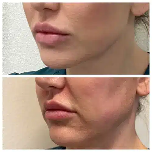 Morpheus8 RF microneedling, profile view, result 5