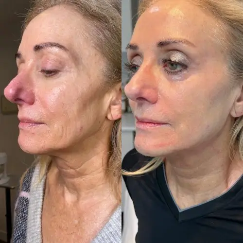 Morpheus8 RF microneedling, profile view, result 6