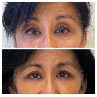Asian blepharoplasty double eyelid surgery, front view, patient in her 50s, case 3