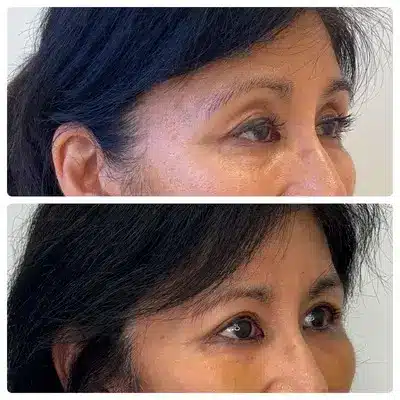 Asian blepharoplasty double eyelid surgery, right oblique, patient in her 50s, case 3