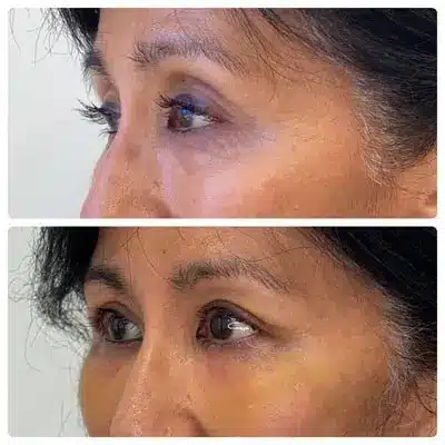 Asian blepharoplasty double eyelid surgery, left oblique, patient in her 50s, case 3