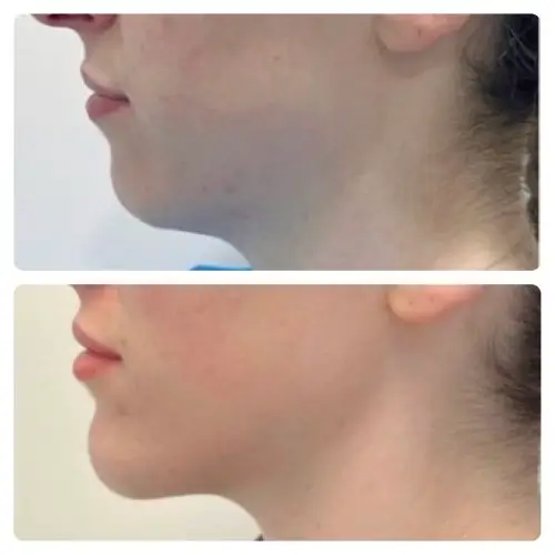 Neck liposuction, left profile, 1 year post-op, case 4
