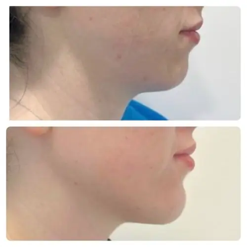 Neck liposuction, right profile, 1 year post-op, case 4