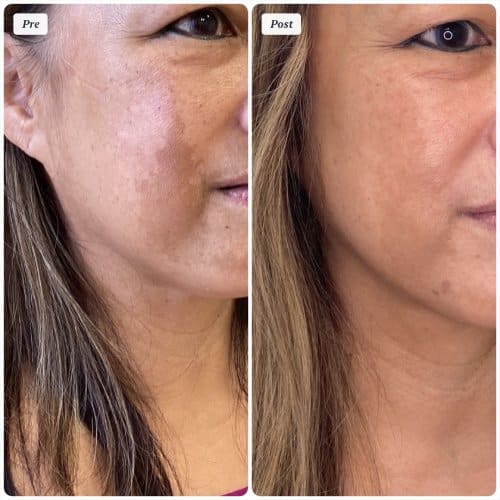 Melasma treatment, right oblique, pigmentation protocol with medical-grade skincare and in-office treatment, case 5