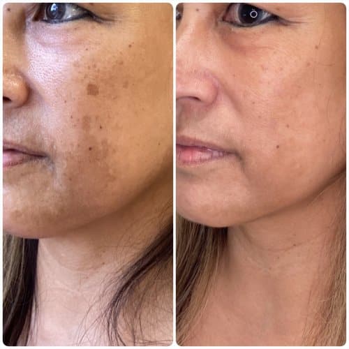 Melasma treatment, left oblique, pigmentation protocol with medical-grade skincare and in-office treatment, case 5