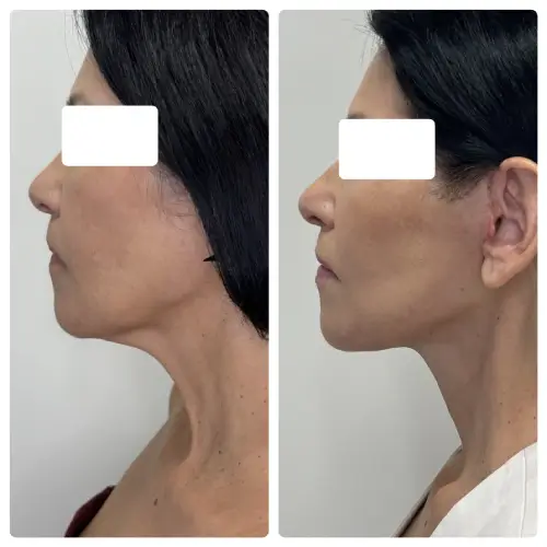 Deep plane facelift and neck lift, left profile, patient in her 50s, case 8