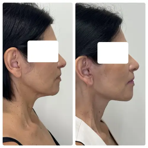Deep plane facelift and neck lift, right profile, patient in her 50s, case 8