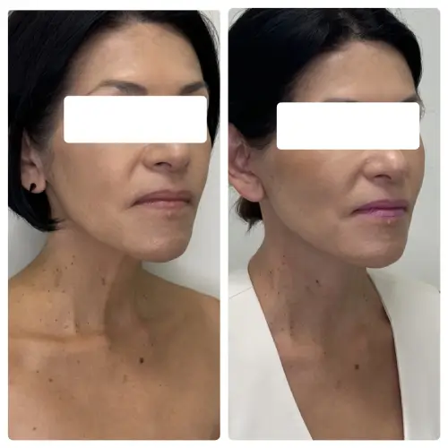 Deep plane facelift and neck lift, right oblique, patient in her 50s, case 8