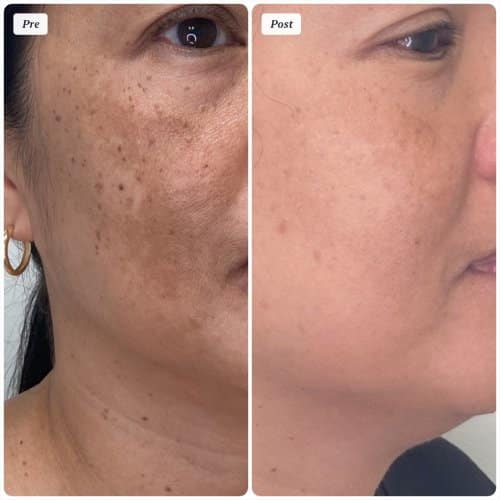 Melasma treatment, right oblique, pigmentation protocol with medical-grade skincare and in-office treatment, case 6