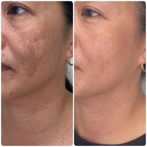 Melasma treatment, left oblique, pigmentation protocol with medical-grade skincare and in-office treatment, case 6