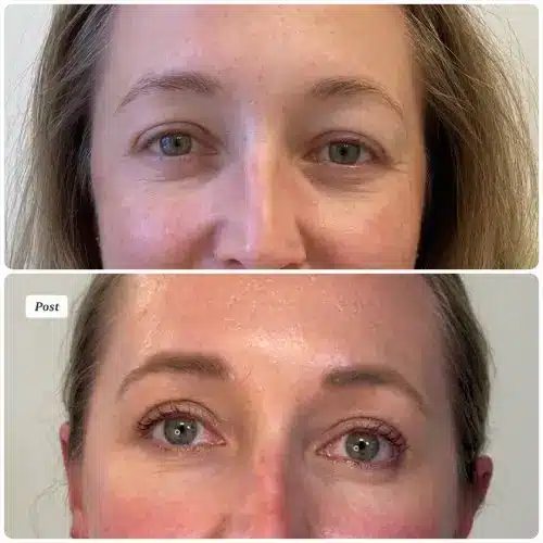 Upper blepharoplasty, front view, patient in her 40s, 1 month post-op, case 3