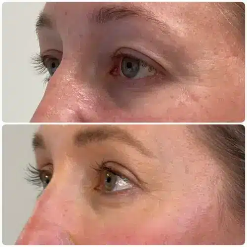 Upper blepharoplasty, left oblique, patient in her 40s, 1 month post-op, case 3