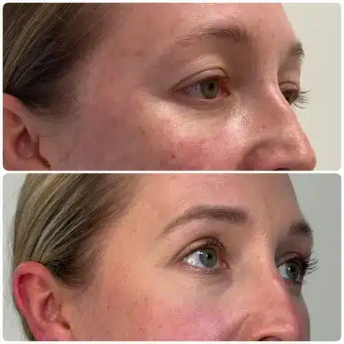 Upper blepharoplasty, right oblique, patient in her 40s, 1 month post-op, case 3