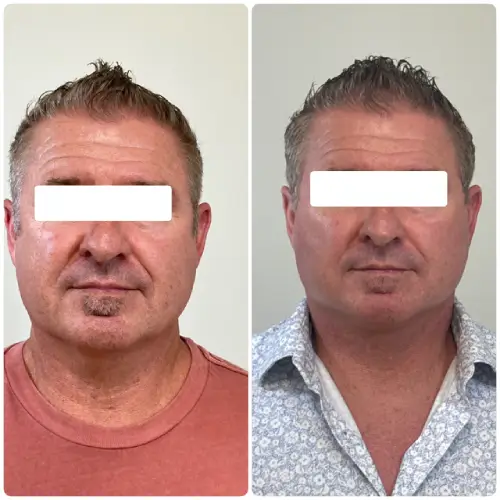 Deep plane facelift and neck lift, front view, 1 month post-op, case 9