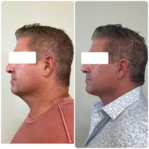 Deep plane facelift and neck lift, left profile, 1 month post-op, case 9