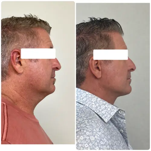 Deep plane facelift and neck lift, right profile, 1 month post-op, case 9