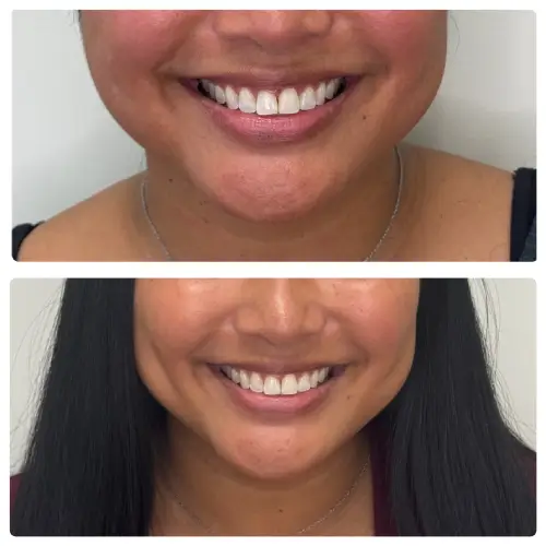 Unilateral dimple creation (right cheek), front view, patient in her 30s, case 2