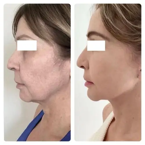 Deep plane facelift and neck lift, left profile, patient in her 60s, 1 year post-op, case 2