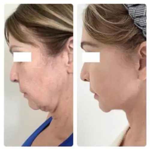 Deep plane facelift and neck lift, left profile, head down, patient in her 60s, 1 year post-op, case 2