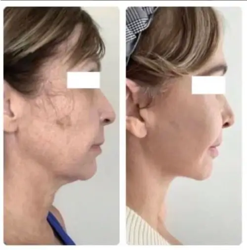 Deep plane facelift and neck lift, right profile, patient in her 60s, 1 year post-op, case 2