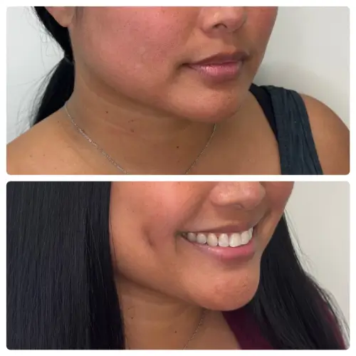 Unilateral dimple creation (right cheek), right oblique, patient in her 30s, case 2