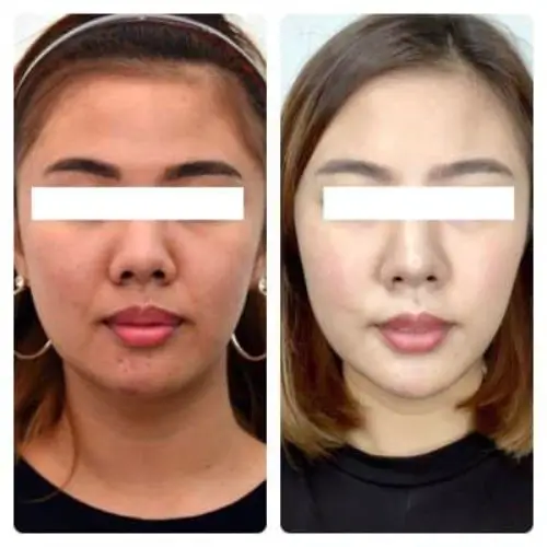 Buccal Fat Removal, front view, patient in her 20s, slimmer lower face, case 3