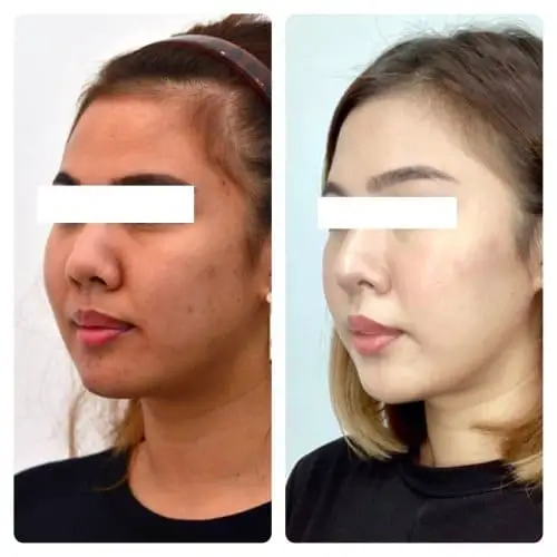 Buccal Fat Removal, left oblique, patient in her 20s, slimmer lower face, case 3