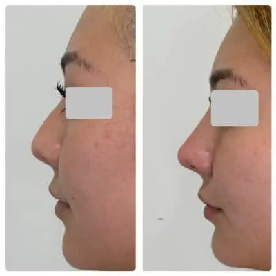 Non-surgical rhinoplasty, left profile, filler nose reshaping, case 1